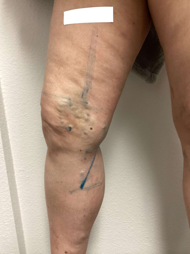Before Image: Varicose Veins - front