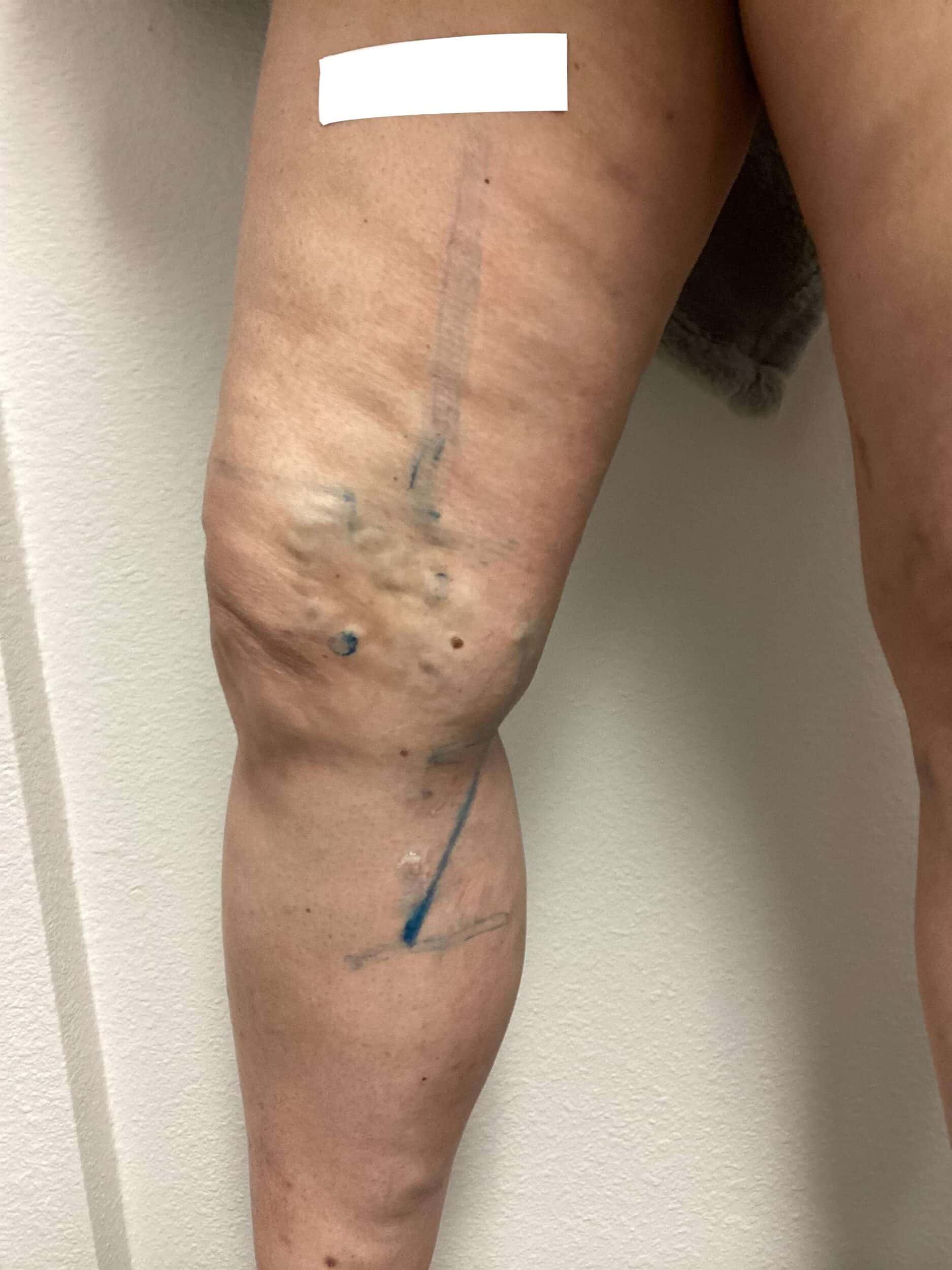 Before Image: Varicose Veins - front