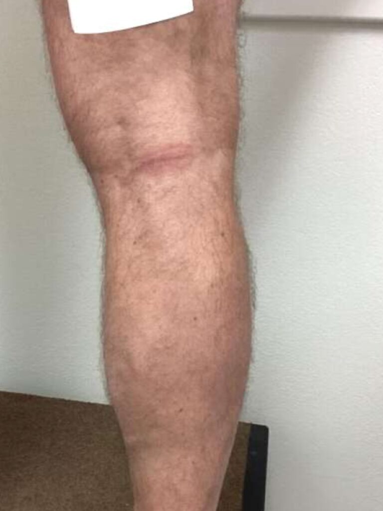 After Image: Varicose Veins - back
