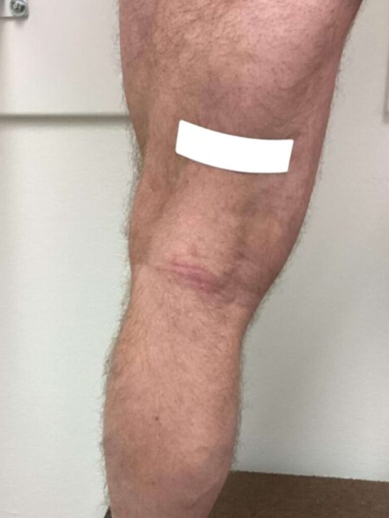 After Image: Varicose Veins - back