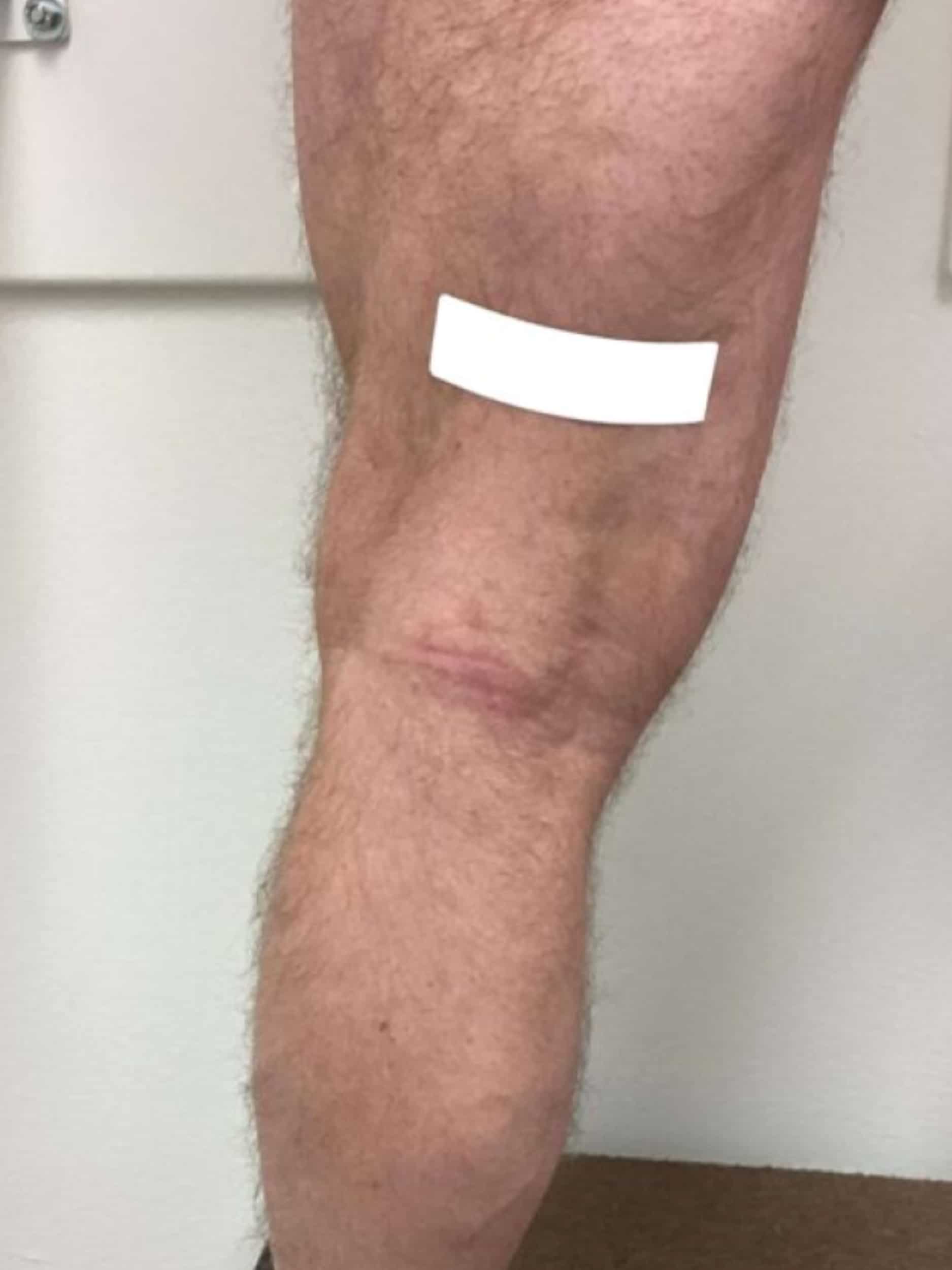 After Image: Varicose Veins - back