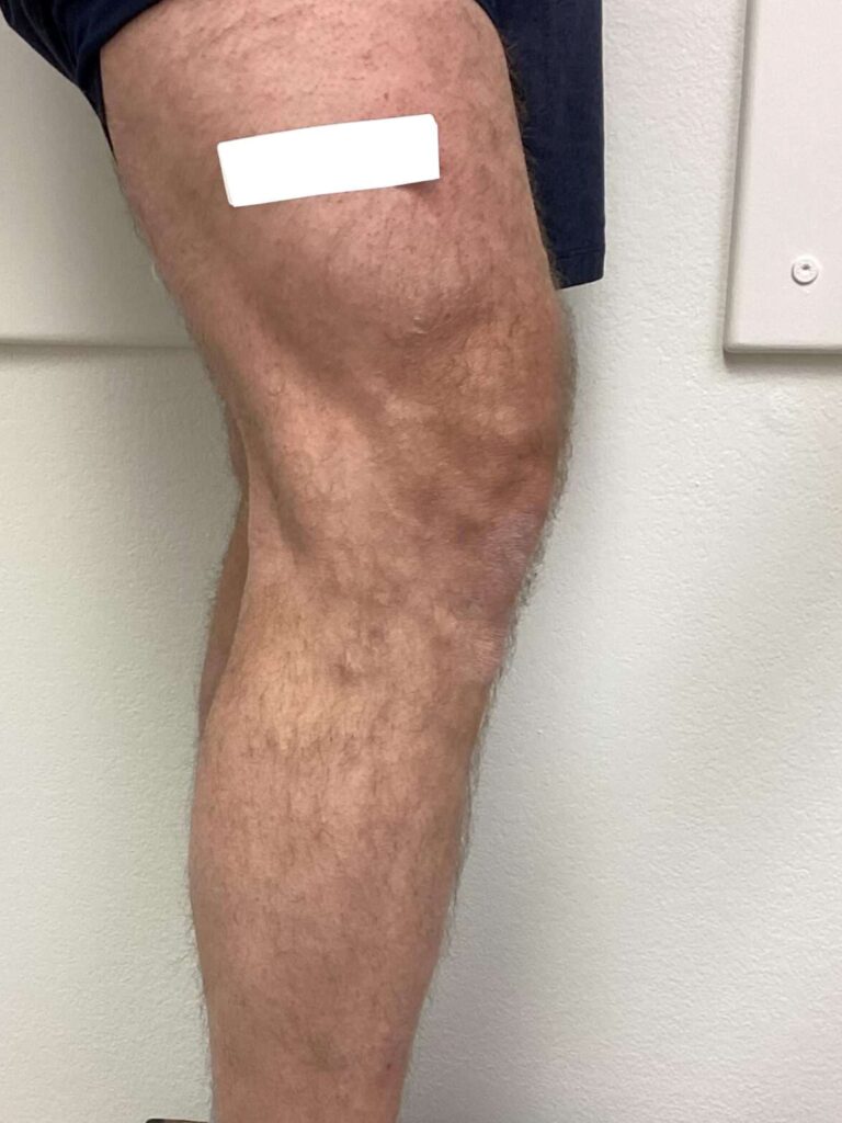 After Image: Varicose Veins - right-side