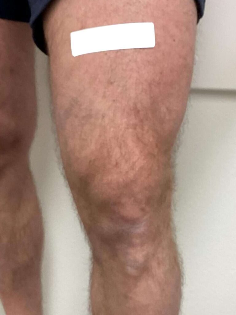 After Image: Varicose Veins - front