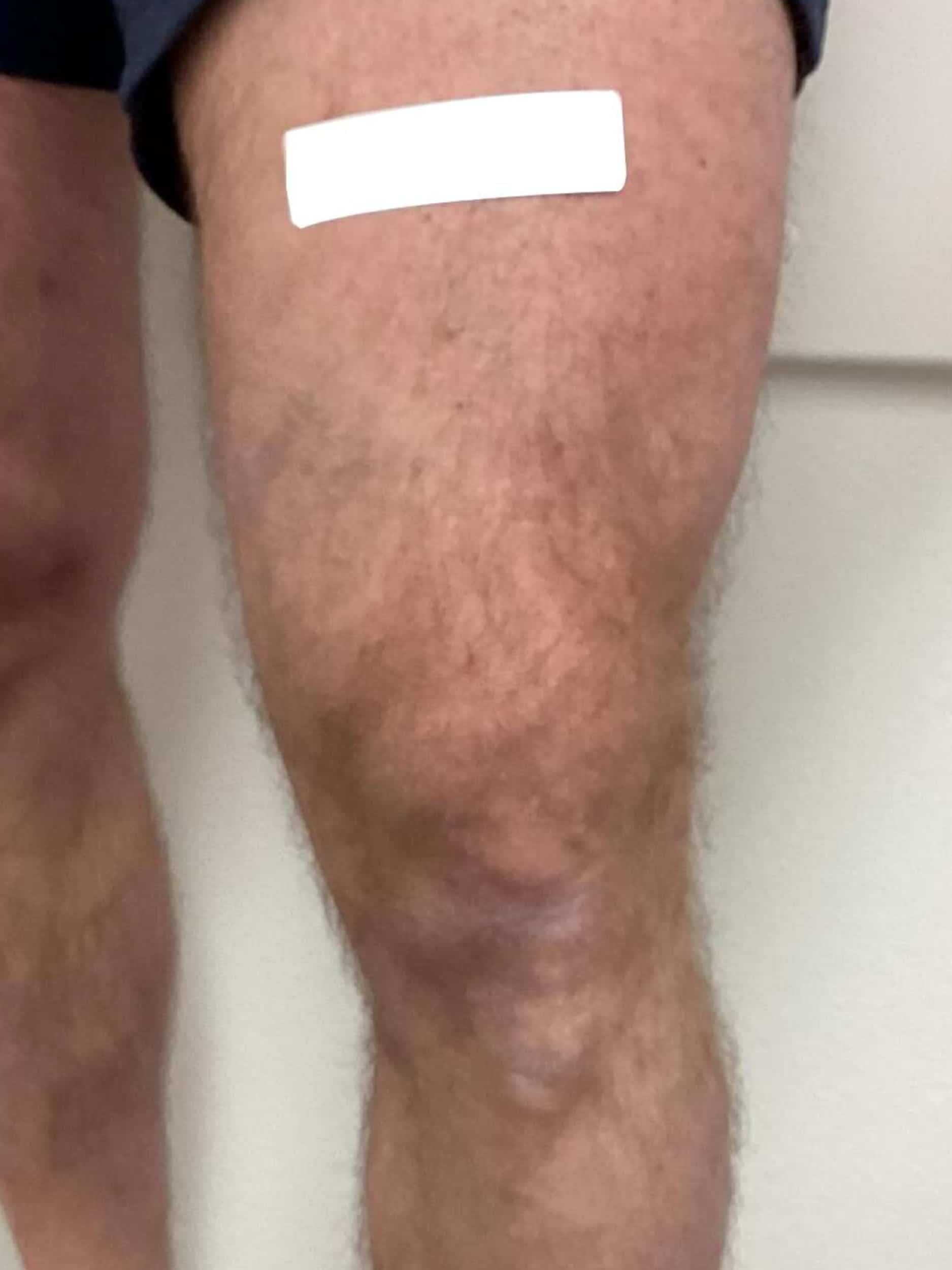 After Image: Varicose Veins - front