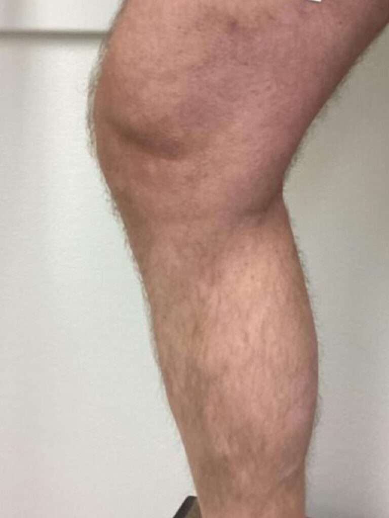 After Image: Varicose Veins - left-side