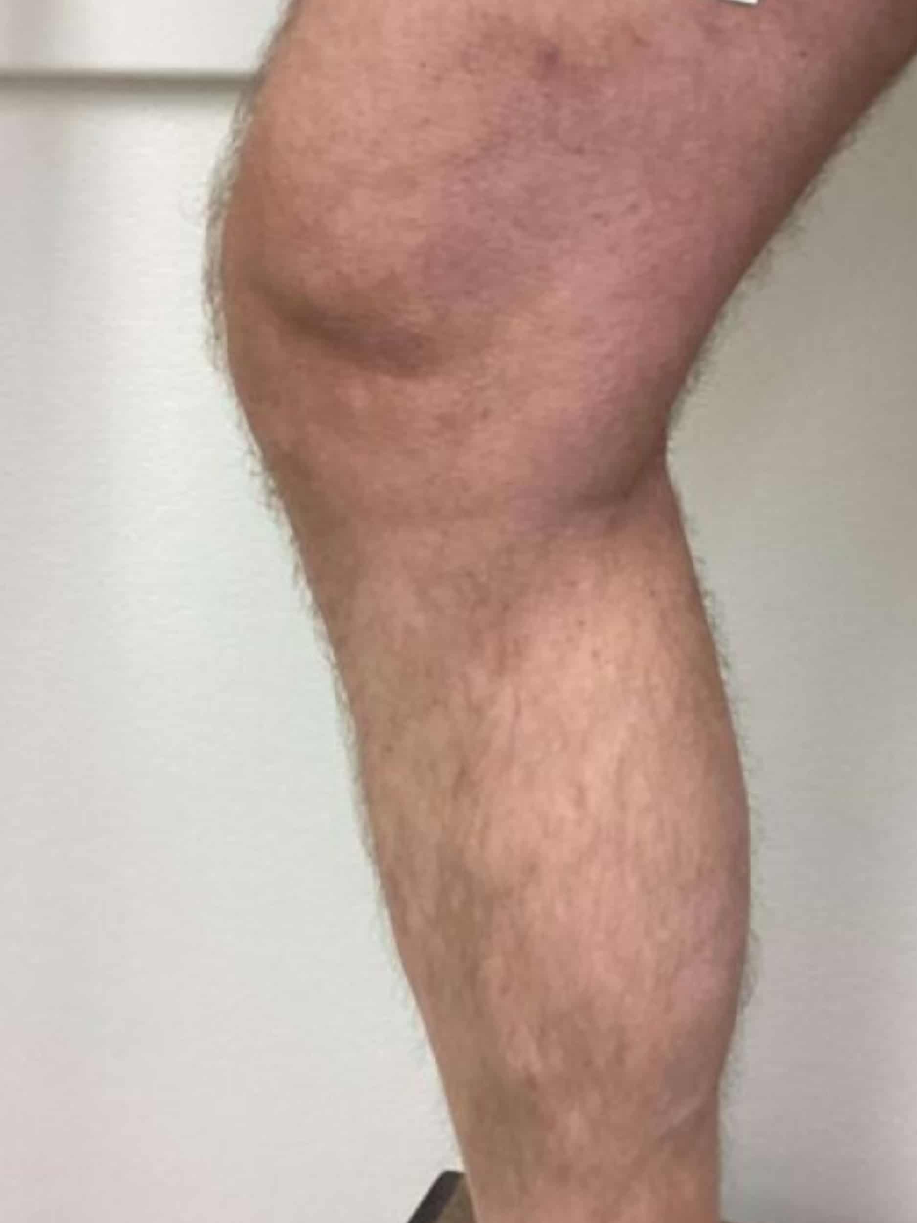 After Image: Varicose Veins - left-side