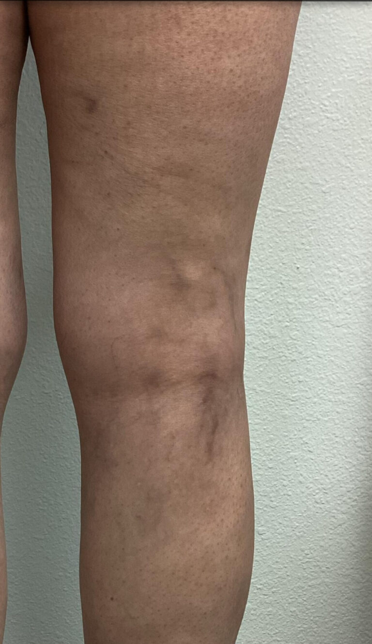 After Image: Spider Veins - right-side