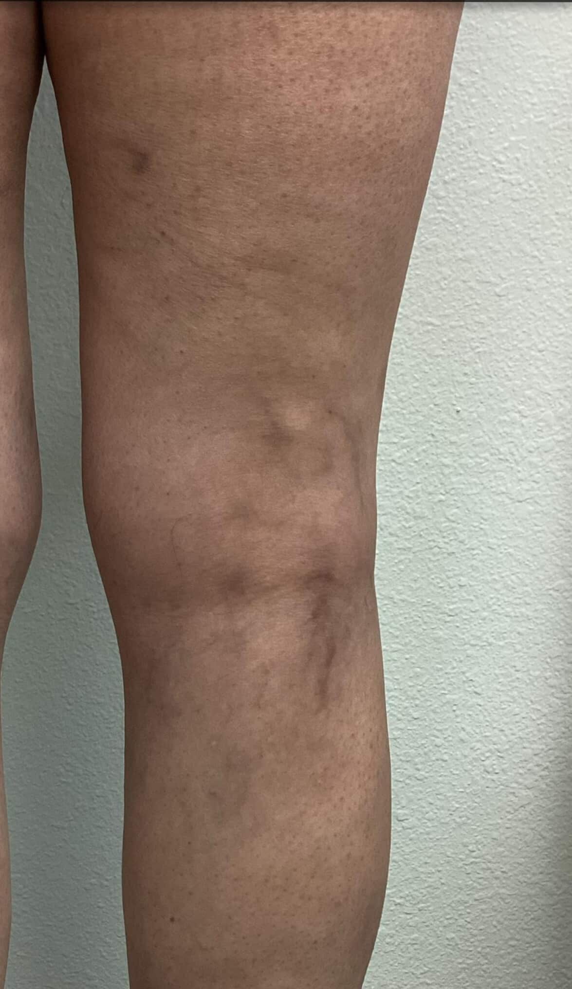 After Image: Spider Veins - right-side