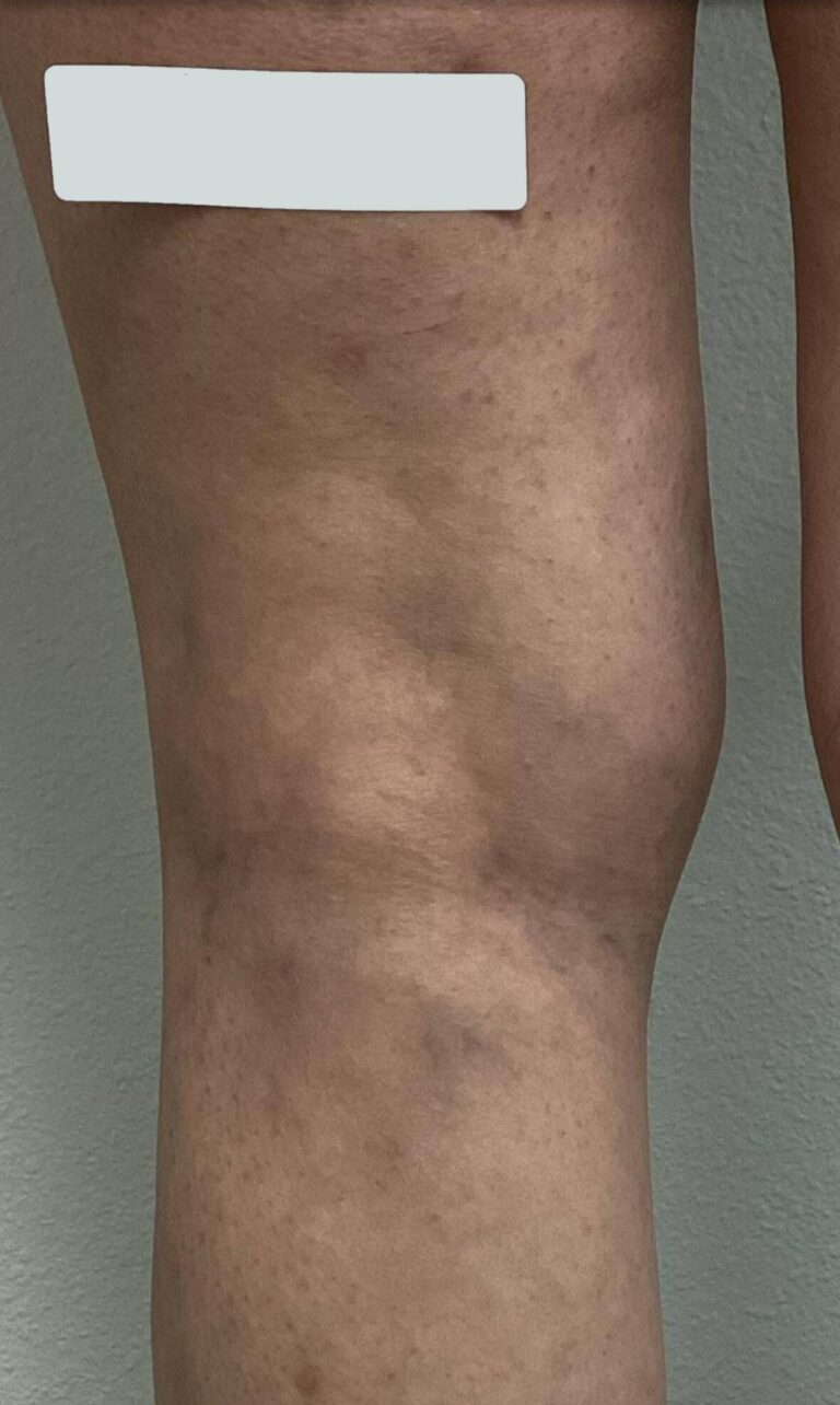 After Image: Spider Veins - back