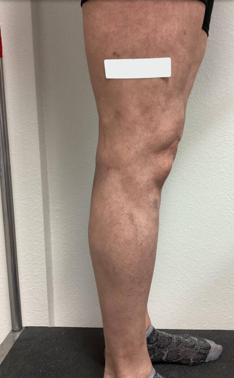 After Image: Spider Veins - back