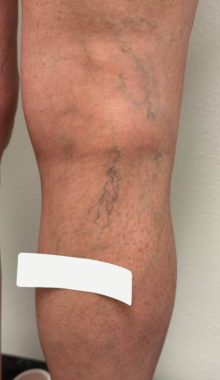 Before Image: Spider Veins - right-side