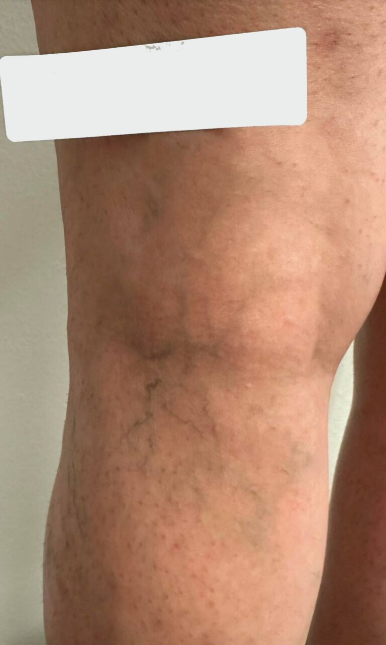 Before Image: Spider Veins - back