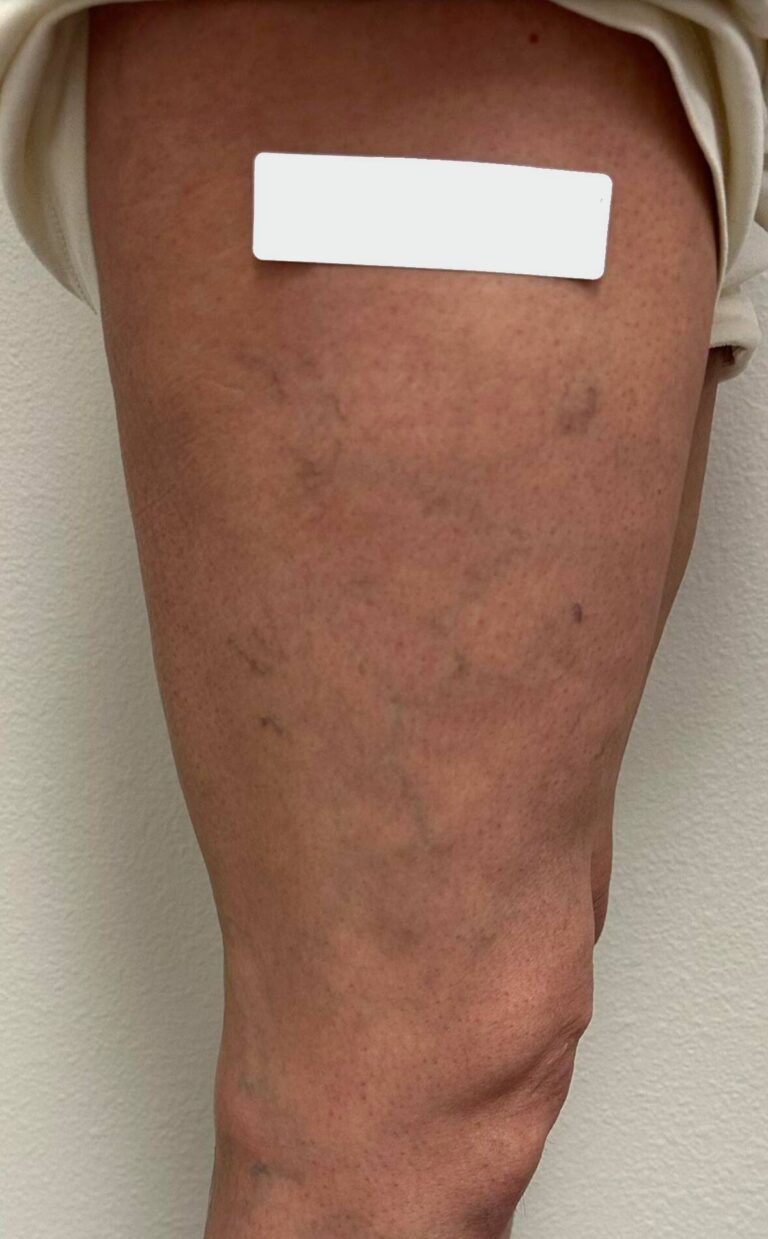 Before Image: Spider Veins - back