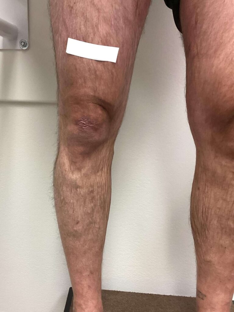 After Image: Varicose Veins - front