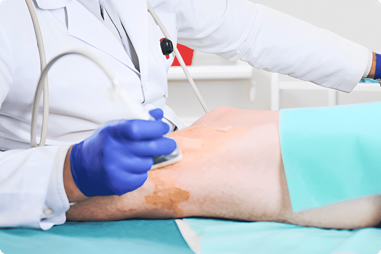 Ultrasound Guided Sclerotherapy Walnut Creek