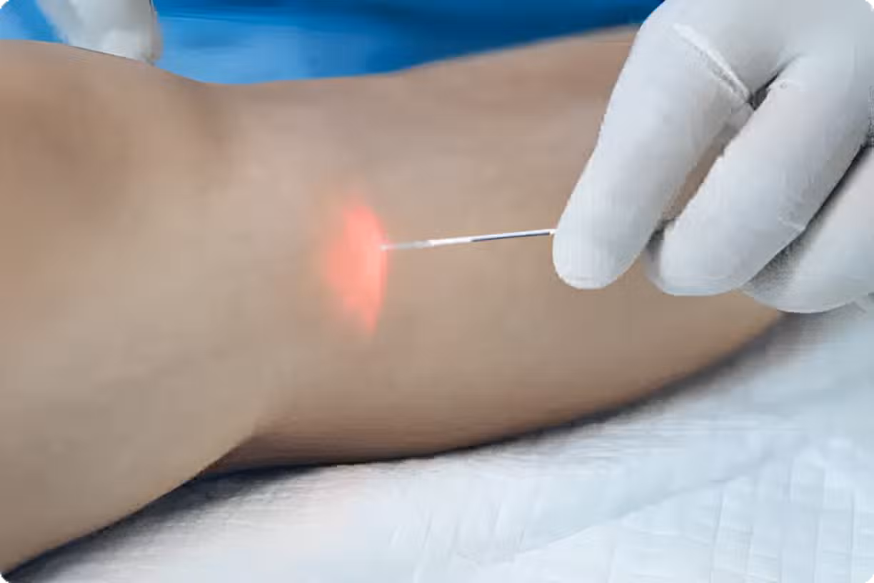 Vein Treatments in Walnut Creek, CA