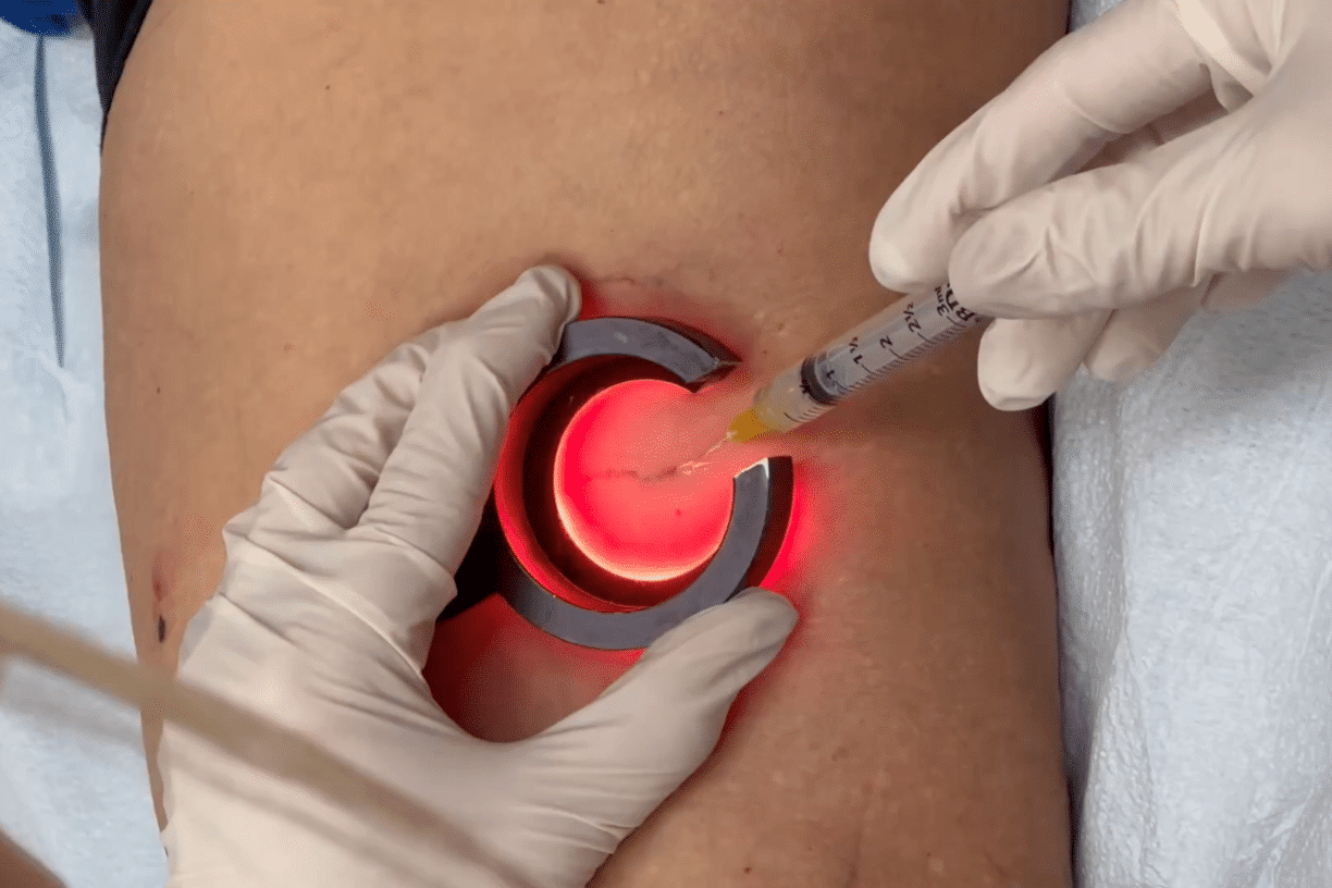 Veinlite Sclerotherapy Walnut Creek